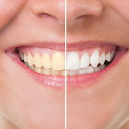 Zahnästhethische Behandlungen